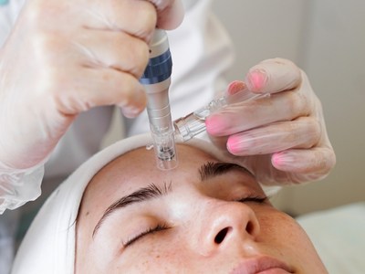 کاربردهای پلاژن تراپی پوست صورت